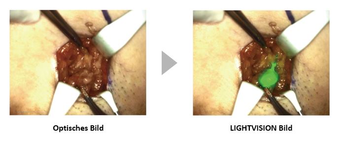 ICG Fluorescence using Near-infrared light