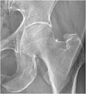 Conventional Noise Reduction